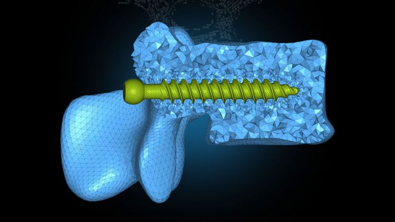 Bei Wirbelsäulenversteifungen setzen Chirurgen meist Pedikelschrauben aus Titan in die Wirbelkörper und verbinden sie mit Metallstäben.